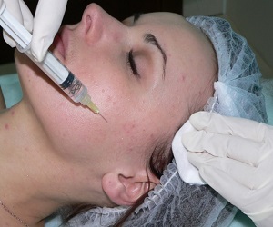 мезоперапия волос до и после фото