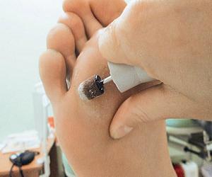 стержневая мозоль удаление фото