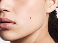 новые родинки на теле