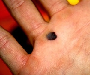 родинки на ладони правой руки значение