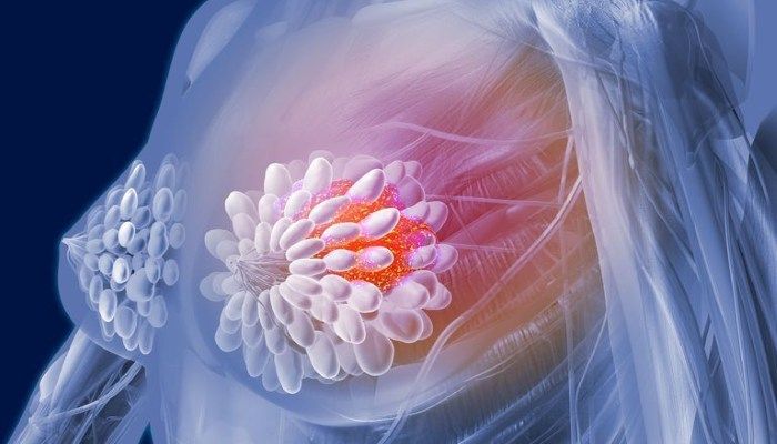 Микрокальцинаты в молочной железе