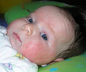 атопический дерматит фото у грудничков