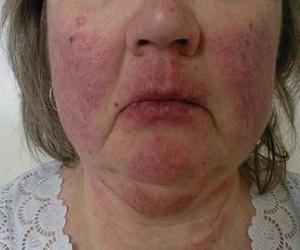 гиперемия кожи фото