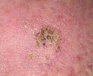 актинический кератоз кожи фото