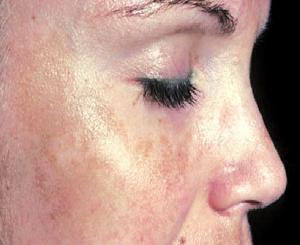 мелазма фото