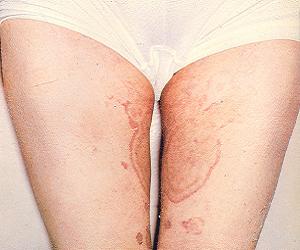 паховая эпидермофития фото у женщин