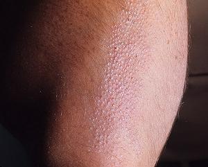 фолликулярный кератоз лечение фото