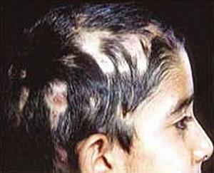 стригущий лишай у ребенка фото