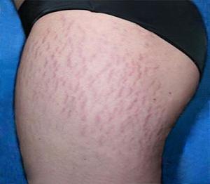 растяжки лечение фото