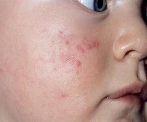 пиодермия у детей симптомы и лечение фото