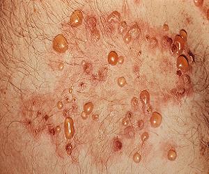 герпетиформный дерматит фото