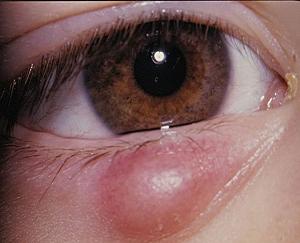 ячмень на глазу фото лечение