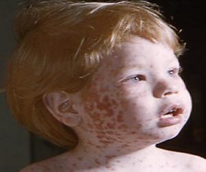 корь у детей сыпь фото