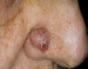 базалиома носа фото