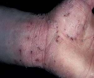 атопический дерматит фото у взрослых