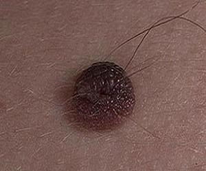 диспластический внутридермальный невус фото