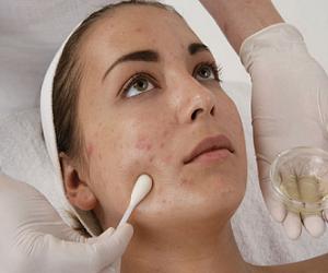 акне лечение фото