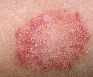 розовый лишай у детей фото лечение