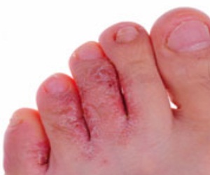 микоз стопы фото