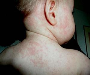 розеола у детей симптомы фото