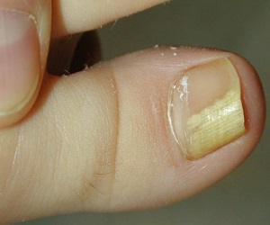 микоз ногтей на ногах