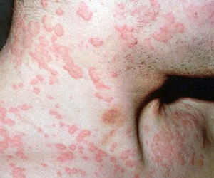 пищевая аллергия симптомы фото