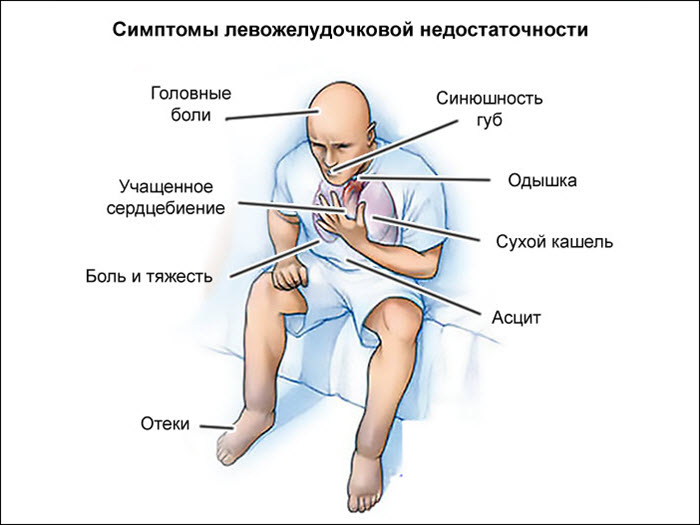 Симптомы сердечной недостаточности