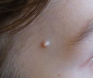 прыщи на лбу и висках причины