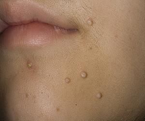 контагиозный моллюск лечение фото