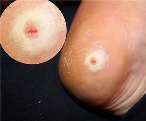 пластырь от натоптышей