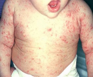 признаки чесотки у детей