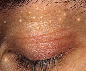 милиумы на веках