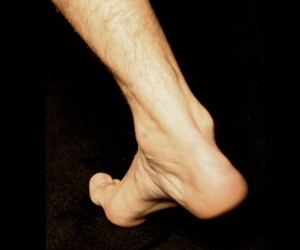 шпоры на пятках причины фото