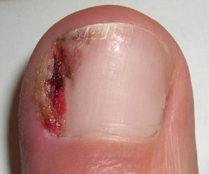 врос ноготь на ноге и гноится