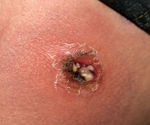 карбункул фото лечение