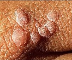 как лечить вирус папилломы человека у мужчин