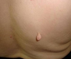 фиброма на спине