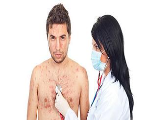 ветрянка у взрослых симптомы и лечение фото