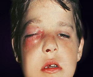 флегмона лица