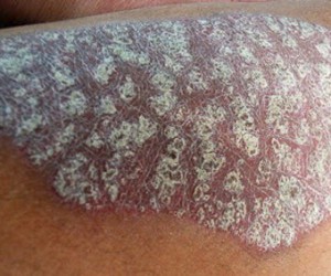 чем лечить псориаз на теле фото