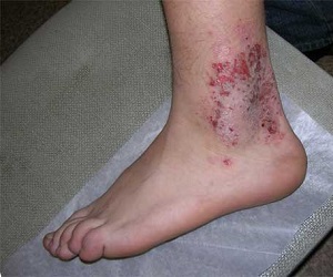 микробная экзема на ногах фото