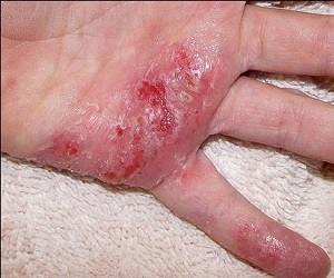 сухая экзема на руках фото