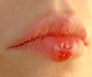 герпес при беременности на ранних сроках