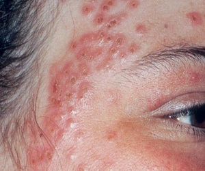 экзема на лице фото начальная стадия