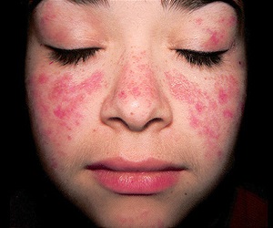 системная красная волчанка патогенез