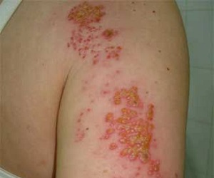 опоясывающий лишай у детей