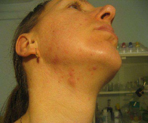 прыщи на шее
