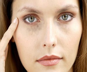 как быстро убрать синяки под глазами