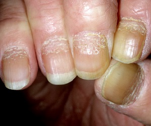 псориаз ногтей фото