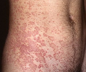 розовый лишай у человека симптомы лечение фото